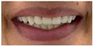 Dental Implants - Fulop Clinic