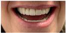 Dental Implants - Fulop Clinic