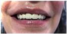 Dental Implants - Fulop Clinic