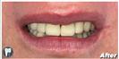 Dental Implants - Fulop Clinic