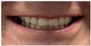 Dental Implants - Fulop Clinic