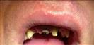 Dental Implants - Fulop Clinic