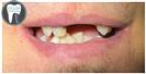 Dental Implants - Fulop Clinic
