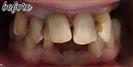 Dental Implants - Fulop Clinic