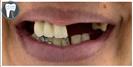 Dental Implants - Fulop Clinic