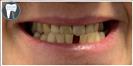 Dental Implants - Fulop Clinic