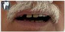 Dental Implants - Fulop Clinic