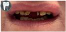 Dental Implants - Fulop Clinic