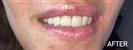 Porcelain Veneers - Fulop Clinic