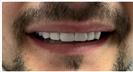 Tooth Bleaching - Fulop Clinic