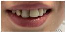 Porcelain Veneers - Fulop Clinic