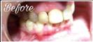 Porcelain Veneers - Fulop Clinic