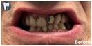Porcelain Veneers - Fulop Clinic