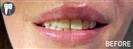 Porcelain Veneers - Fulop Clinic