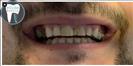 Tooth Bleaching - Fulop Clinic