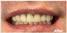 Teeth Cleaning - Fulop Clinic