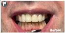 Teeth Cleaning - Fulop Clinic