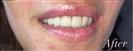 Tooth Bleaching - Fulop Clinic