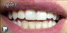 Tooth Bleaching - Fulop Clinic