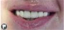 Tooth Bleaching - Fulop Clinic