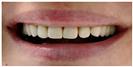 Tooth Bleaching - Fulop Clinic