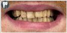 Tooth Bleaching - Fulop Clinic