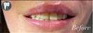 Tooth Bleaching - Fulop Clinic