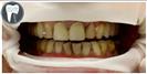 Tooth Bleaching - Fulop Clinic