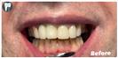 Tooth Bleaching - Fulop Clinic