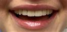 Tooth Bleaching - Fulop Clinic
