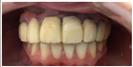Tooth Bleaching - Fulop Clinic