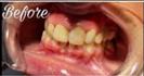Tooth Bleaching - Fulop Clinic