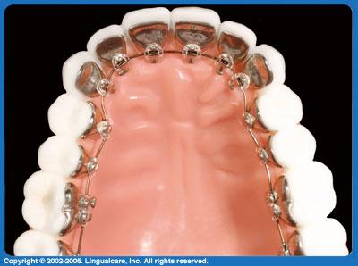 Customised lingual i-braces - BRACES Dental Centre