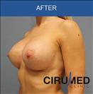 Breast Implants - Cirumed Clinic