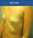 Breast Implants - Cirumed Clinic