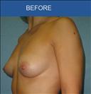 Breast Implants - Cirumed Clinic