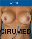 Breast Lift - Cirumed Clinic