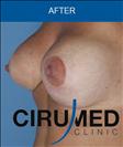 Breast Lift - Cirumed Clinic