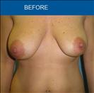 Breast Lift - Cirumed Clinic