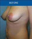 Breast Lift - Cirumed Clinic