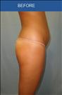 Brazilian Butt Lift - Cirumed Clinic