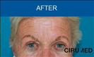 Blepharoplasty - Cirumed Clinic