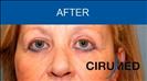 Blepharoplasty - Cirumed Clinic