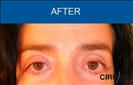 Blepharoplasty - Cirumed Clinic