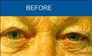 Blepharoplasty - Cirumed Clinic