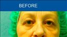 Blepharoplasty - Cirumed Clinic