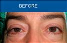 Blepharoplasty - Cirumed Clinic