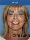 Facelift - Cirumed Clinic