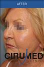 Facelift - Cirumed Clinic