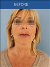 Facelift - Cirumed Clinic